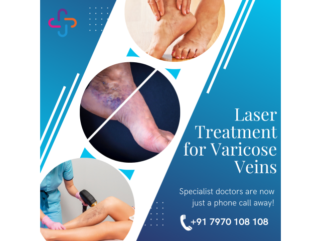 Laser Treatment for Varicose Veins in Coimbatore | Sri Ramakrishna Hospital